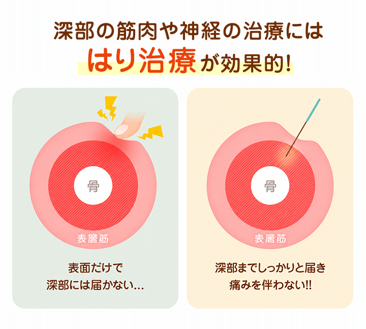 深部の筋肉や神経の治療にははり治療が効果的！